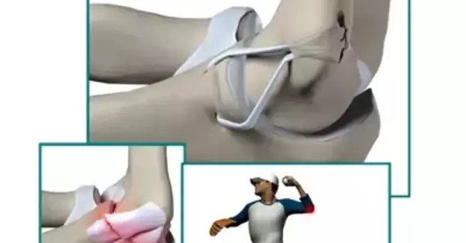 Ulnar Collateral Ligament Surgery image