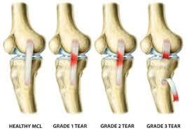 MCL/LCL Sprain