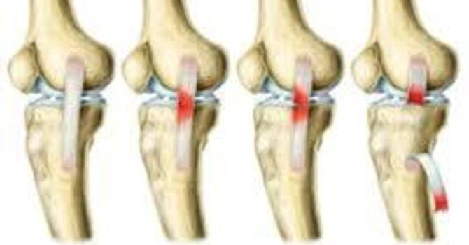 Comprehensive Guide to Managing an MCL/LCL Sprain image