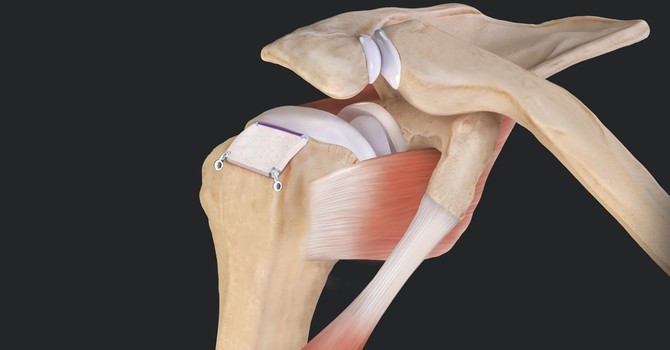 Shoulder Tuberoplasty: Relief from Shoulder Impingement image