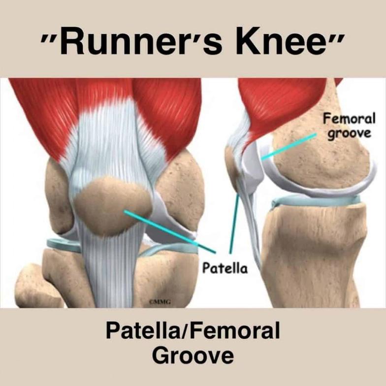 Patellofemoral Syndrome