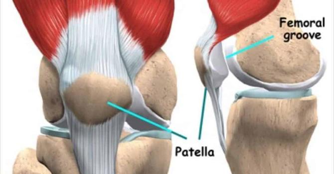 Patellofemoral Syndrome: Understanding and Treating Knee Pain image