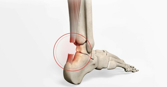 Achilles Tendon Repair: Recovering from a Ruptured Achilles