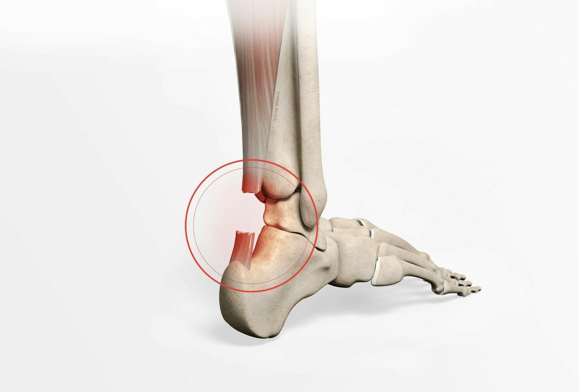 Achilles Tendon Repair