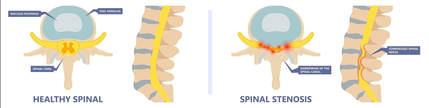 Cox Technique for Spinal Stenosis