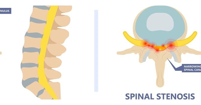 Cox Technique for Spinal Stenosis image