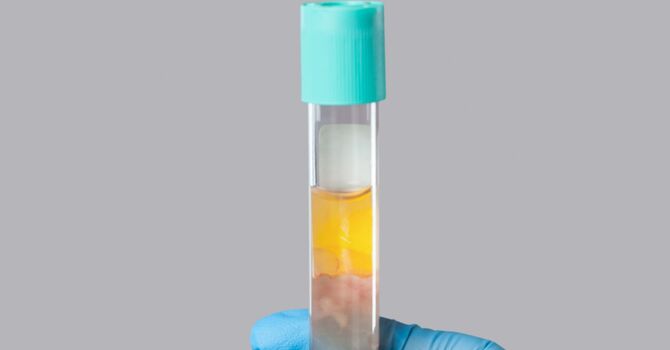 High Density PRP for Joint Pain: <