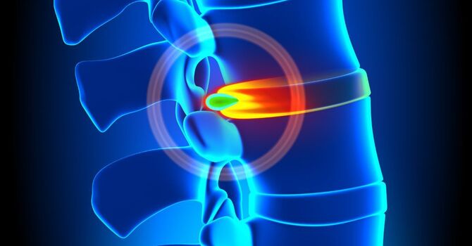 Cox Technique for Disc Pain image